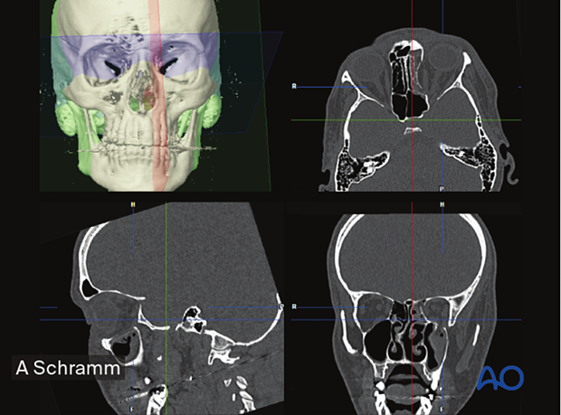 Preoperative CT scans in multiplanar views consisting of 3D reconstruction, axial, coronal, sagittal views – computer assisted surgery.