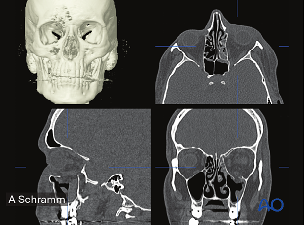 Preoperative 3D reconstruction, axial, coronal, sagittal CT scans views showing the correct orientation of the data set according to the patient's anatomy –– computer assisted surgery.