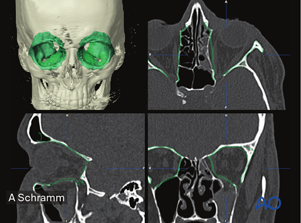Preoperative 3D reconstruction, axial, coronal, sagittal CT scans views showing auto segmentation of the unaffected orbit mirrored to the affected side –– computer assisted surgery.