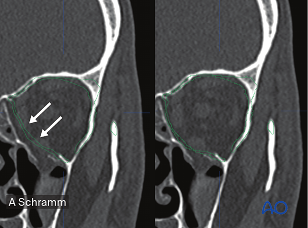 Arrows on the CT scans showing the contours of the auto-segmented orbits virtually drawn, erased, and bent – computer assisted surgery.