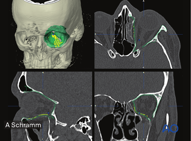 Preoperative 3D reconstruction, axial, coronal, sagittal CT scans views showing the virtual insertion of the anatomically preformed titanium mesh – computer assisted surgery.