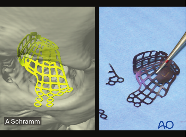 Trimming the preformed orbital implant – computer assisted surgery..