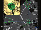 Preoperative 3D reconstruction, axial, coronal, sagittal CT scans views showing the pointer on the posterior orbital shelf, indicating the correct position of the posterior end of orbital floor reconstruction – computer assisted surgery.