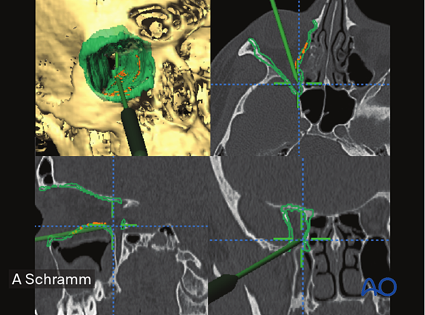 Preoperative 3D reconstruction, axial, coronal, sagittal CT scans views showing the pointer on the posterior orbital shelf, indicating the correct position of the posterior end of orbital floor reconstruction – computer assisted surgery.