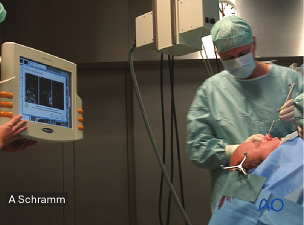 Clinical photograph showing the navigation pointer placed on the surface of the orbital implant – computer assisted surgery.