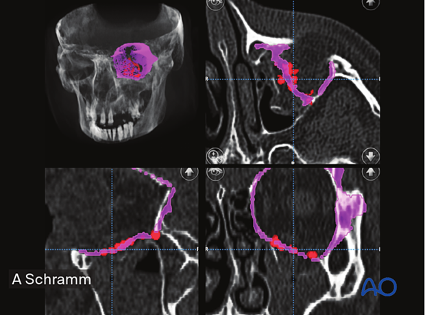 Preoperative multiplanar views, axial, coronal, sagittal CT scans views showing the position of the implant visualized by red spots – computer assisted surgery.