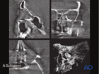 Preoperative multiplanar CT scan views to verify the correct anatomic shape and position of the titanium mesh used for orbital wall reconstruction – computer assisted surgery
