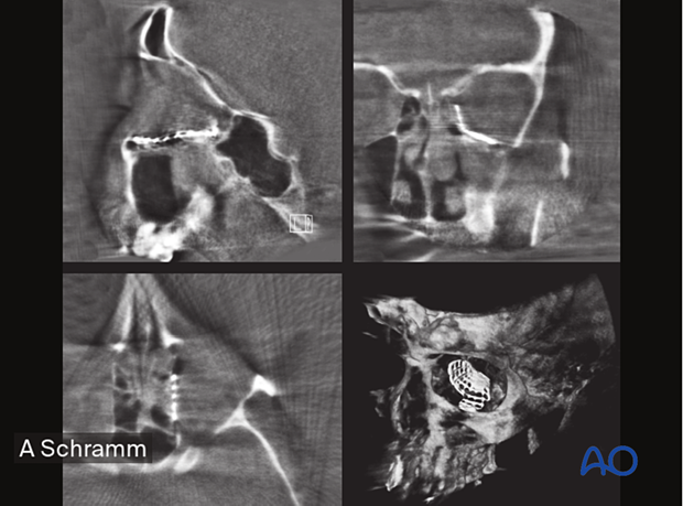 Preoperative multiplanar CT scan views to verify the correct anatomic shape and position of the titanium mesh used for orbital wall reconstruction – computer assisted surgery.