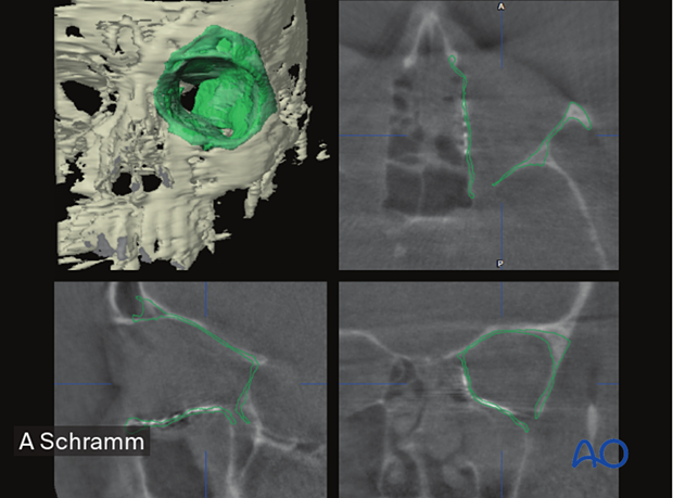 Preoperative 3D reconstruction, axial, coronal, sagittal CT scans views showing auto segmentation of the unaffected orbit mirrored to the affected side –– computer assisted surgery.