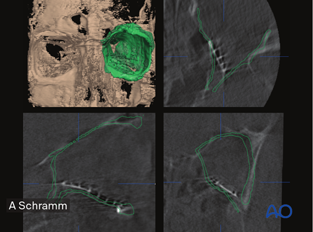 Multiplanar 3D reconstruction, axial, coronal, sagittal CT scans views showing orbital walls have not been adequately reconstructed –– computer assisted surgery.