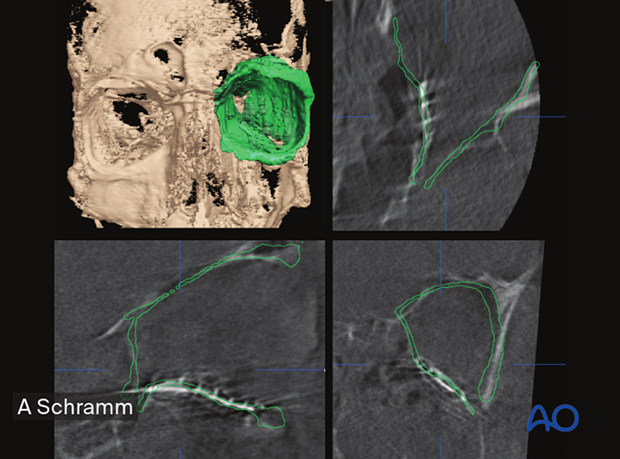 Multiplanar 3D reconstruction, axial, coronal, sagittal CT scans views showing adequately reconstructed orbital walls –– computer assisted surgery.