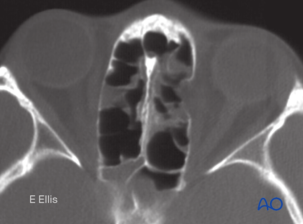 CT scan slice of a medial orbital wall fracture.