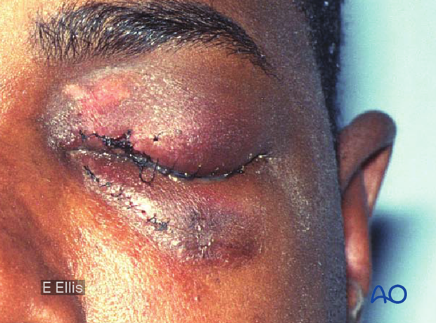 Clinical photograph of a patient with an orbital fracture.