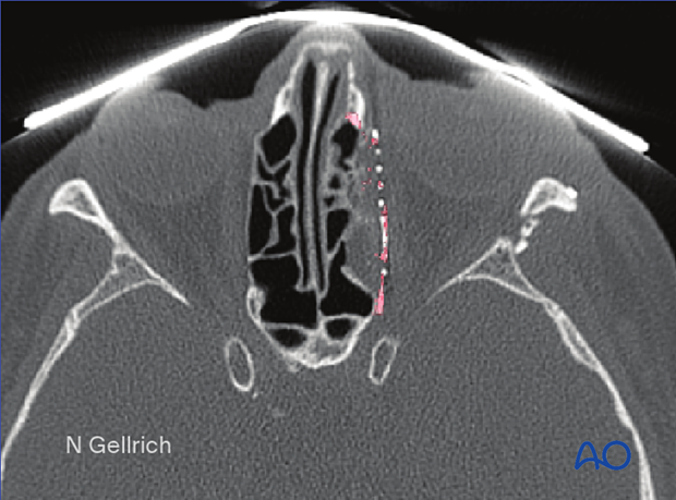 CT scan slice showing a lateral orbital wall fracture.