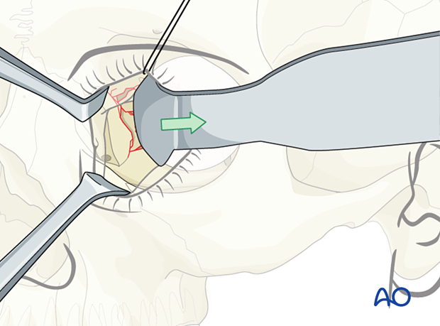 Retraction of the intraorbital soft tissue during orbital wall reconstruction.