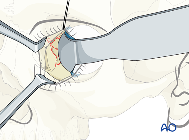 The retractor is removed, placed under the foil, and the orbital soft tissues are adequately retracted during orbital wall reconstruction.