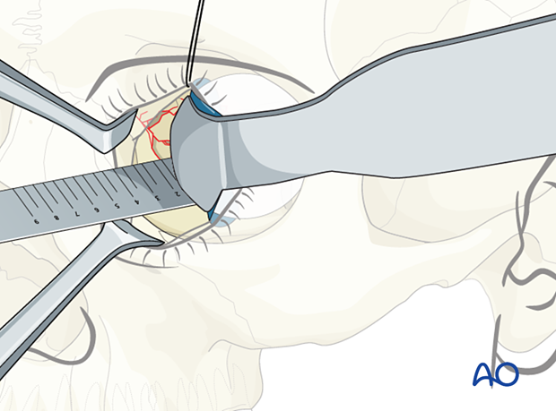 Measuring the defect size with a measuring instrument during orbital wall reconstruction.