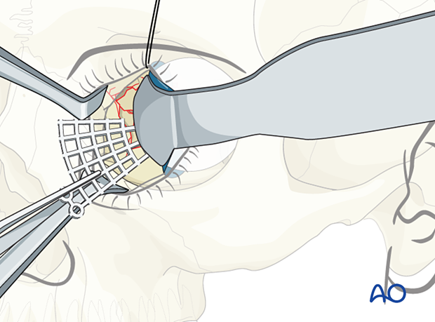 Insertion of titanium mesh plate under the retractor and foil during orbital wall reconstruction.