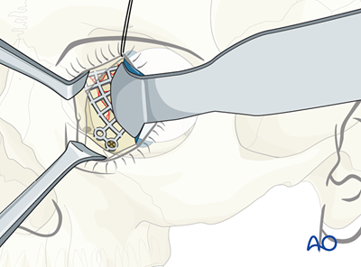 Reconstruction for Medial orbital wall fracture