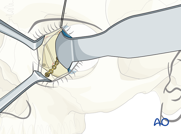 Calvarial bone graft stabilized by a titanium fixation plate.to the orbital rim in orbital wall reconstruction.