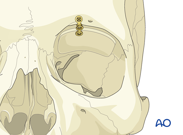 Calvarial bone graft stabilized by a titanium fixation plate.to the orbital rim in orbital roof reconstruction.