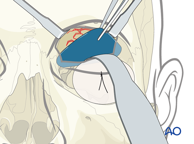 Insertion of a foil below the retractor for orbital roof reconstruction.