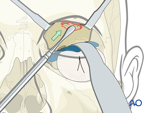 Reduction of an orbital roof fracture.