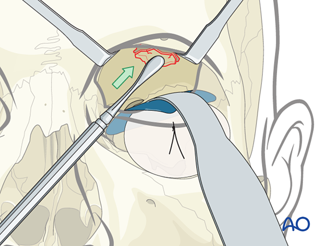 Open treatment for Orbital roof fracture