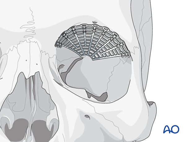 A sterile artificial skull showing placement of a titanium mesh plate on the orbital roof.