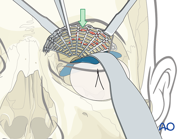 Insertion of titanium mesh plate during orbital floor reconstruction.