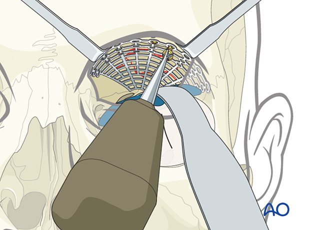 Fixation of the titanium mesh with one screw in orbital roof reconstruction.