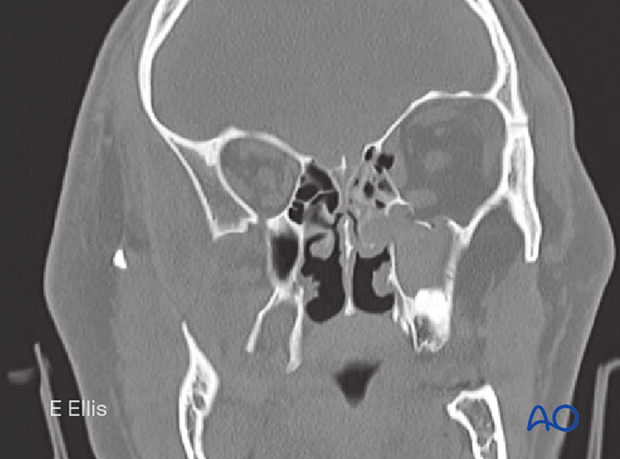 Observation of orbital fractures