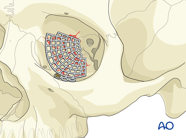 Fixation of the titanium mesh with one screw in anterior floor of the orbit just posterior to the orbital rim in combined orbital fracture reconstruction.