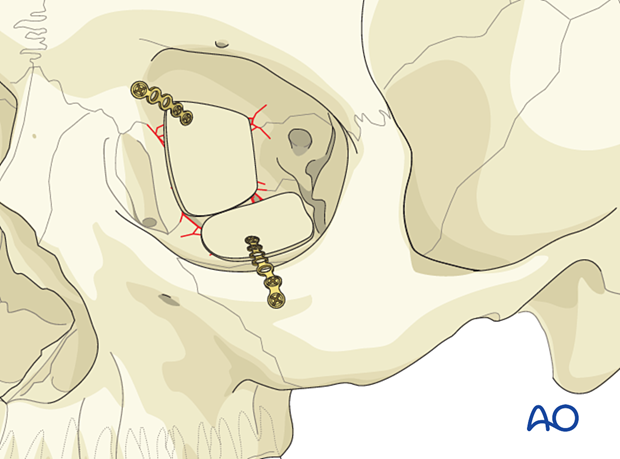 Calvarial bone graft stabilized by a titanium fixation plate.to the orbital rim in a combined orbital floor and wall reconstruction.