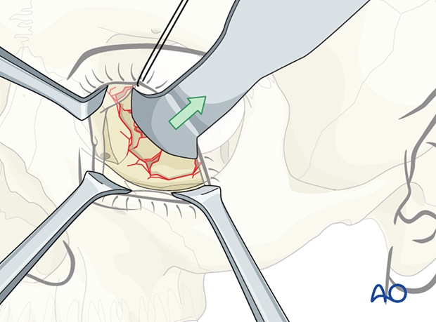 Retraction of the intraorbital soft tissue during combined orbital floor and wall reconstruction.