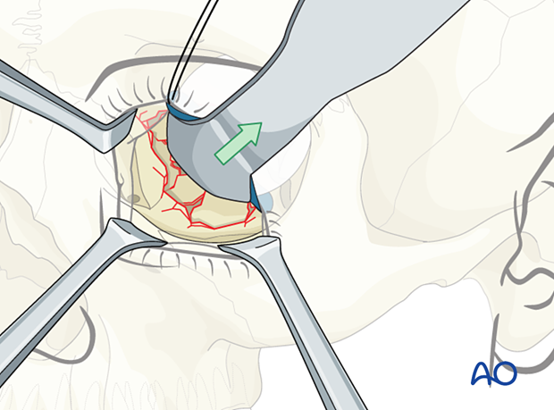 Retractor placed under the foil, and the orbital soft tissues are adequately retracted during combined orbital floor and wall reconstruction.