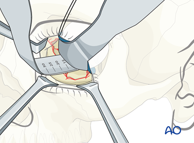 Lower Helical Rim Reconstruction Reconstruction for Orbit, combined fractures
