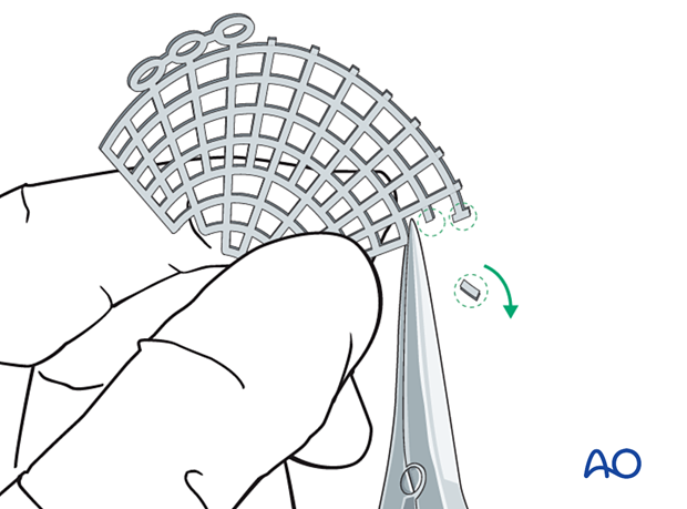Titanium mesh plate trimmed to protect soft tissues during combined orbital floor and wall reconstruction.