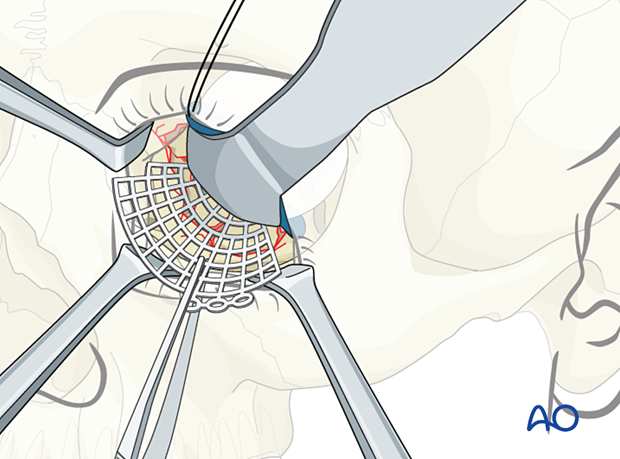 Insertion of titanium mesh plate under the retractor and foil during combined orbital floor and wall orbital reconstruction.