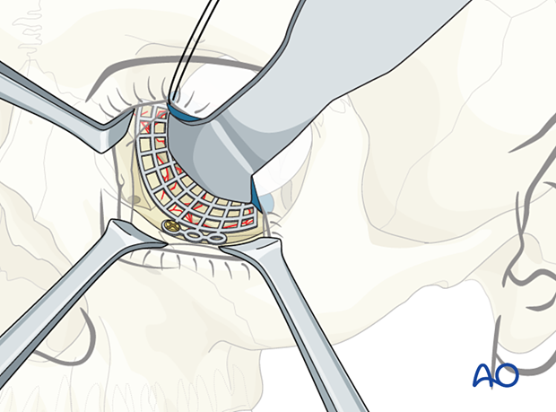 Fixation of the titanium mesh with one screw in anterior floor of the orbit just posterior to the orbital rim in combined orbital fracture reconstruction.