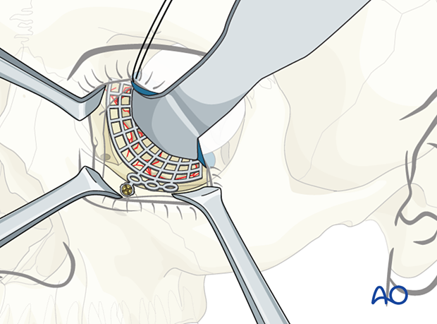 Titanium mesh extending over the orbital rim and fixed with one screw combined orbital fracture reconstruction.