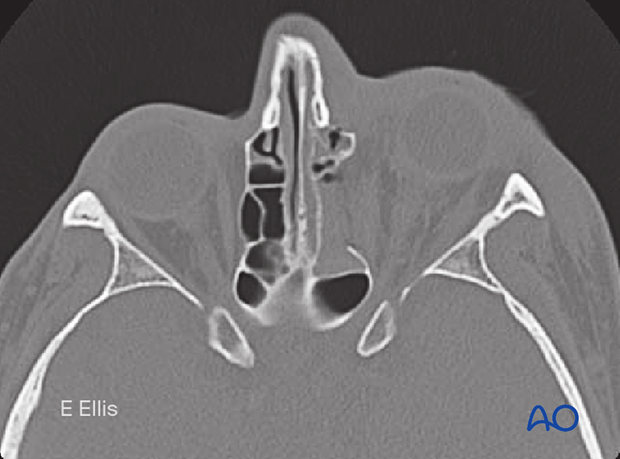 Axial CT slice showing the medial wall component of a combined orbital floor and medial wall fracture.