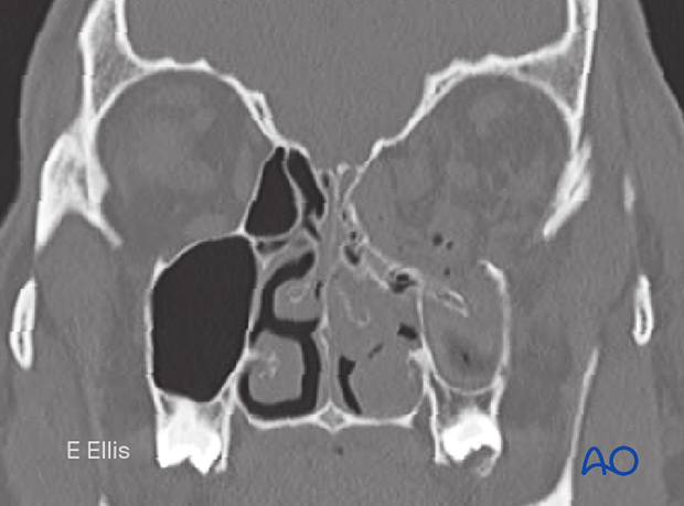 Coronal CT slice showing the combined medial wall and orbital floor fractures.