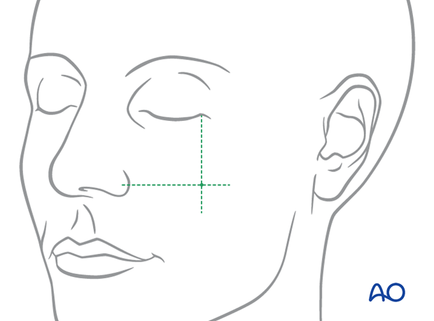 The proper location for applying the bone hook for closed reduction of an isolated zygomatic arch fracture.