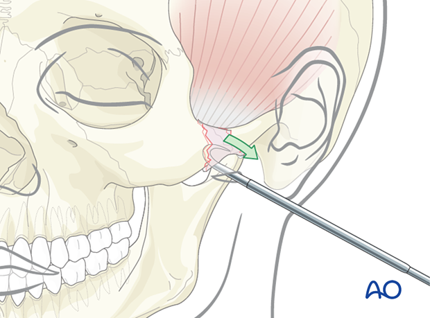 Placing the percutaneous hook through the skin for closed reduction of an isolated zygomatic arch fracture.