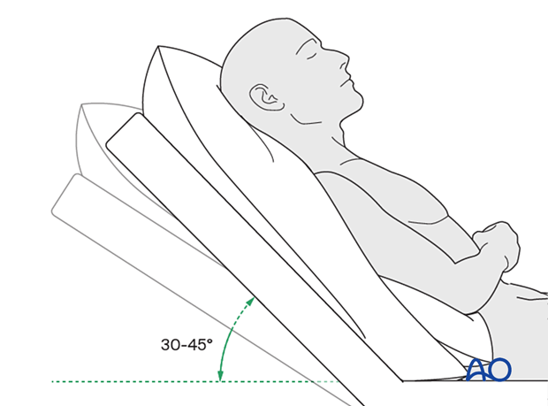 Postoperative patient positioning with head at 30-degree angulation.