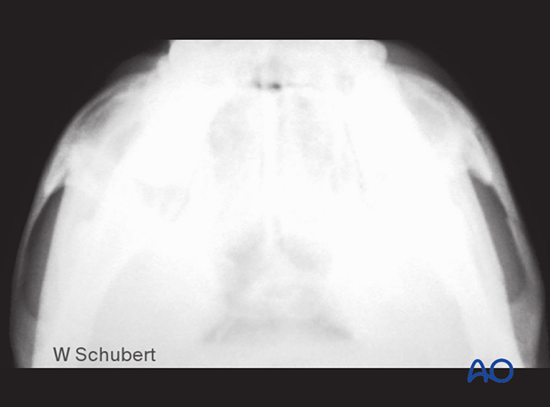 Postoperative image in submentovertex view used to visualize the reduction of an isolated zygomatic arch fracture.