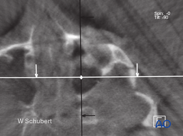 Intraoperative image showing an isolated zygomatic arch fracture before reduction.