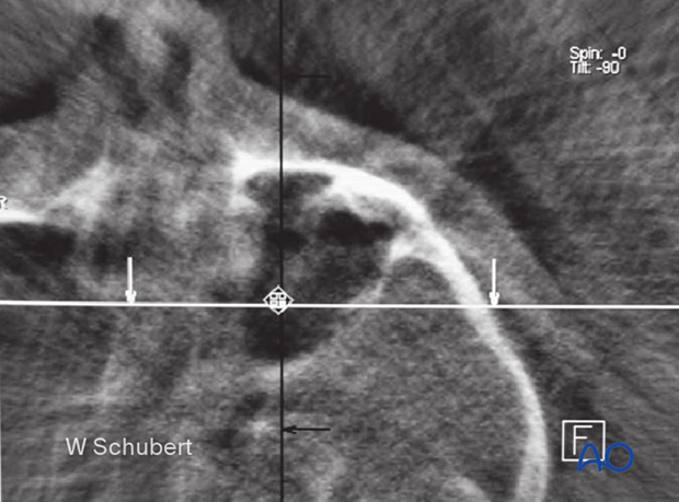 Intraoperative image showing an isolated zygomatic arch fracture after reduction.