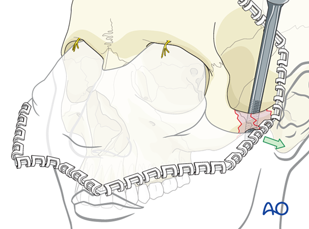 Elevating fragments of the zygomatic arch through the coronal approach to reduce an isolated zygomatic arch fracture.